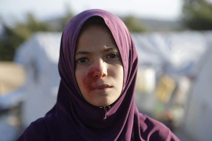 مرض جلدي خطير يُهدد 300 طفل في...