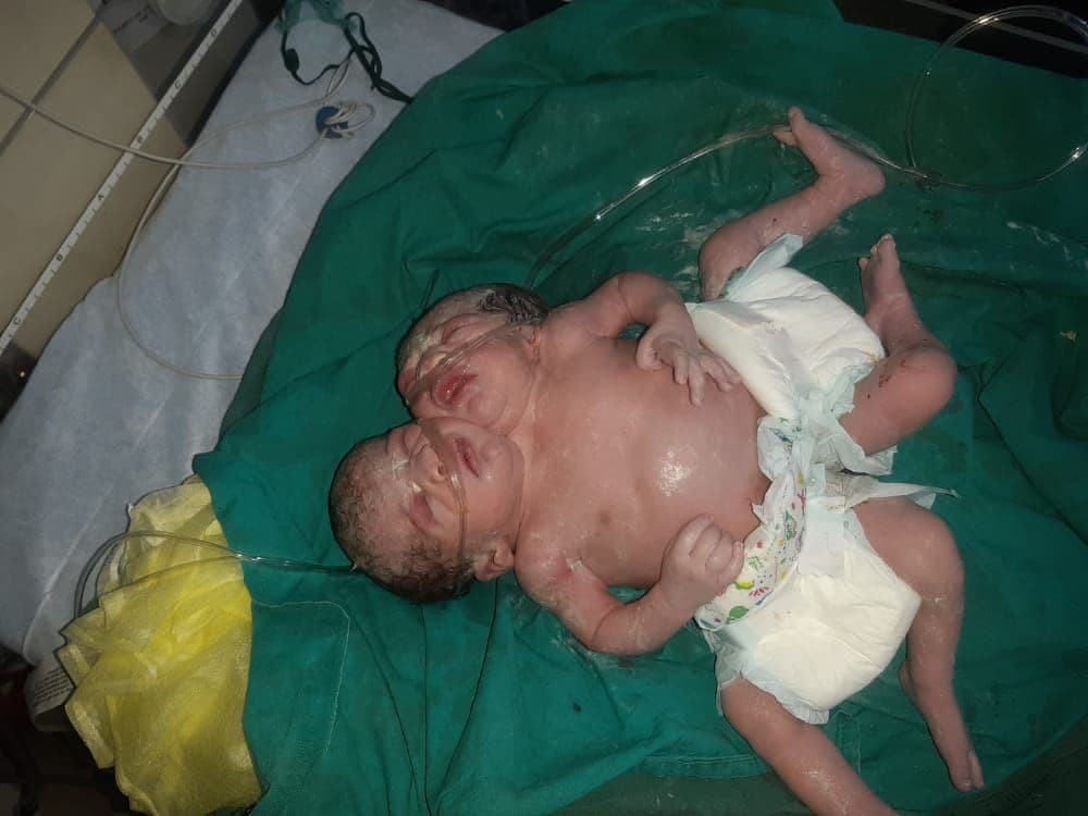 ولادة توأم سيامي في عفرين.. وت...