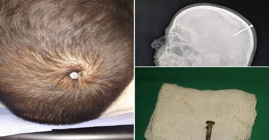 استخراج مسمار من رأس سوري في ح...