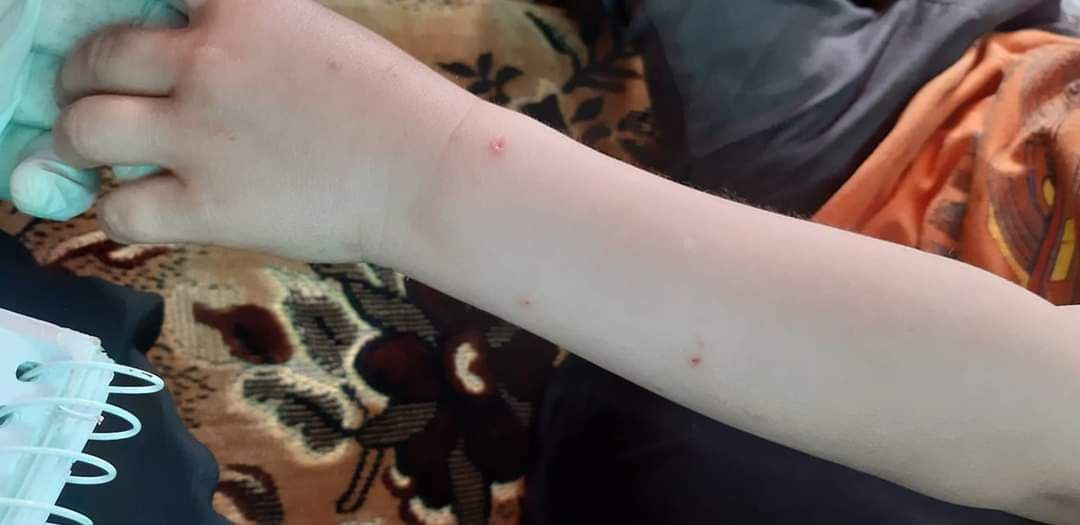 الأمراض الجلدية تفتك بأطفال مخ...