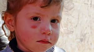 بالآلاف "اللاشمانيا" تجتاح ريف...