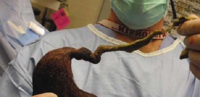 فتاة تبتلع 4 كيلو غرام من شعره...