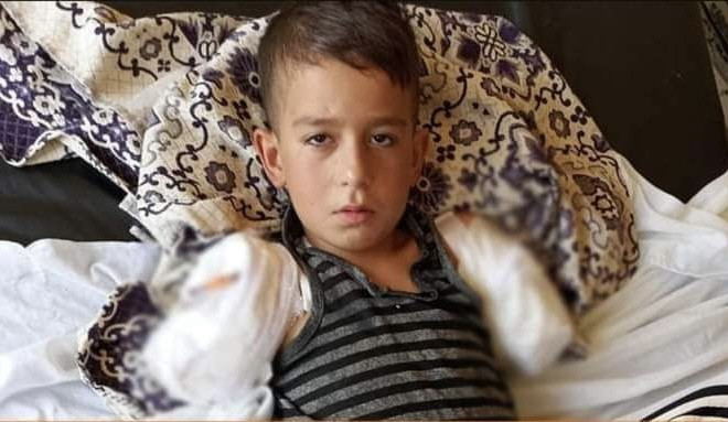 بتر يدي طفل تعرض لصعق كهربائي...