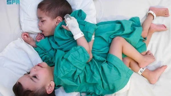 نجاح عملية فصل التوأم السيامي...