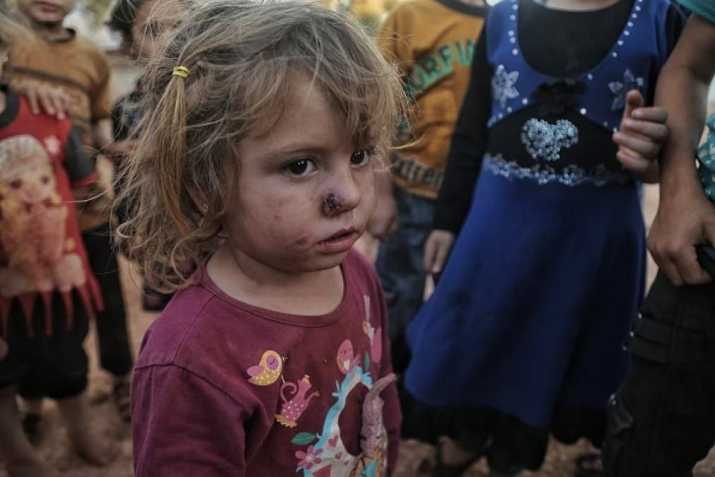 تسجيل 14.642 إصابة بداء اللاشم...