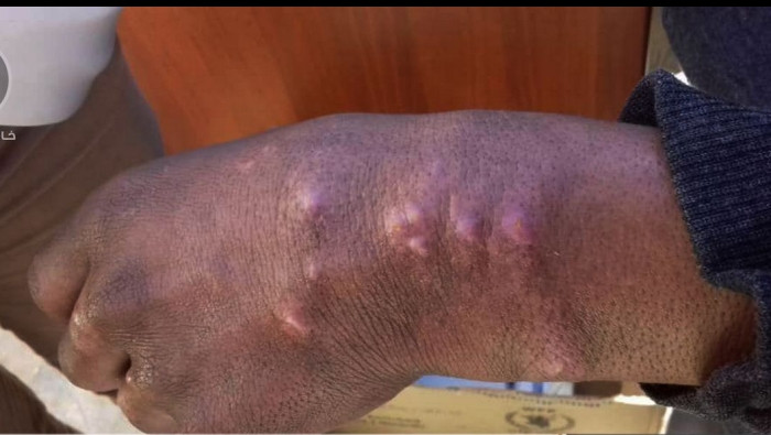 "الليشمانيا" تفتك بسكان دير ال...