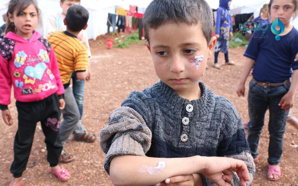 "اللشمانيا" تزيد مخاوف النازحي...