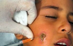 "اللشمانيا" يتفشى بين سكان الب...