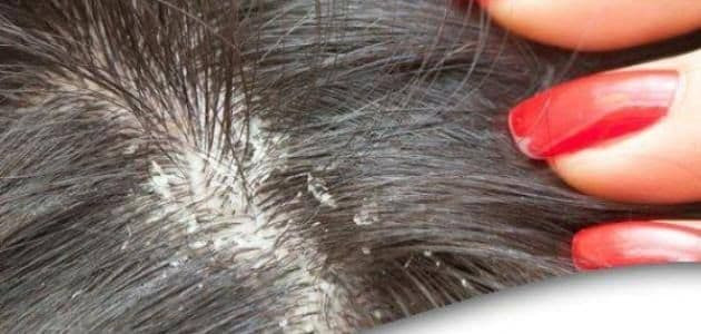 5 علاجات منزلية للقشرة وحكة فر...