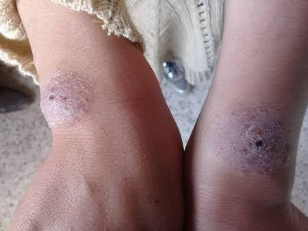 "اللشمانيا" تغزو مخيمات النزوح...