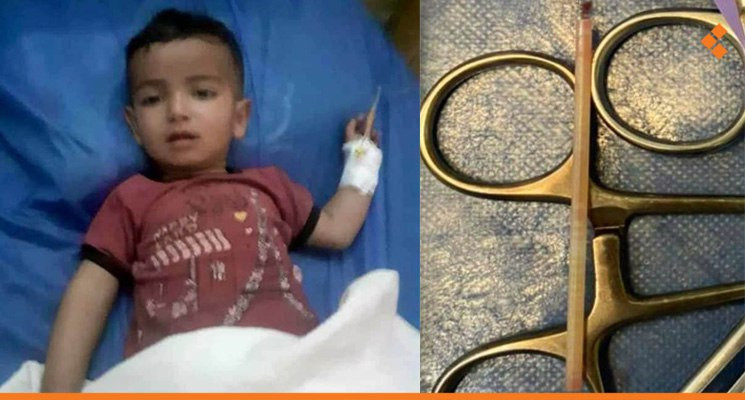 استخراج عود "مصاص" من معدة طفل...