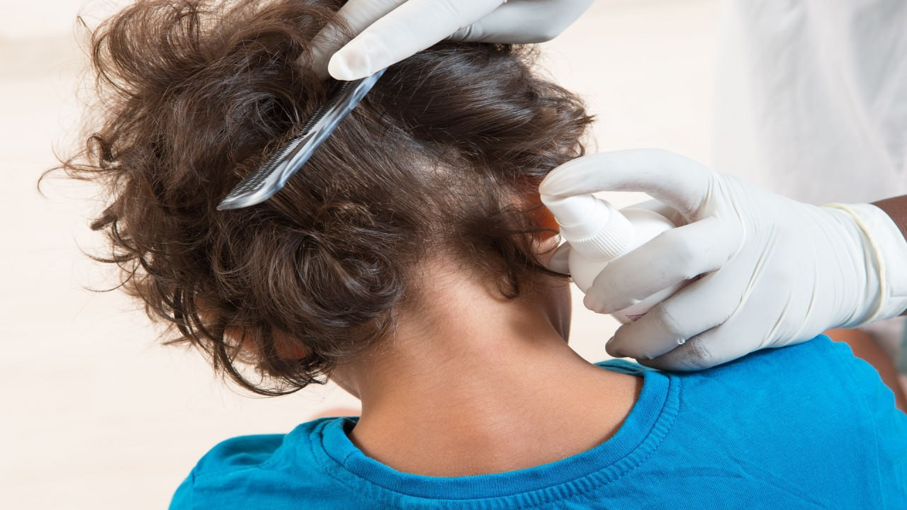 انتشار القمل بين طلاب المدارس...