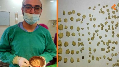 استخراج 150 حصوة من مثانة مريض...