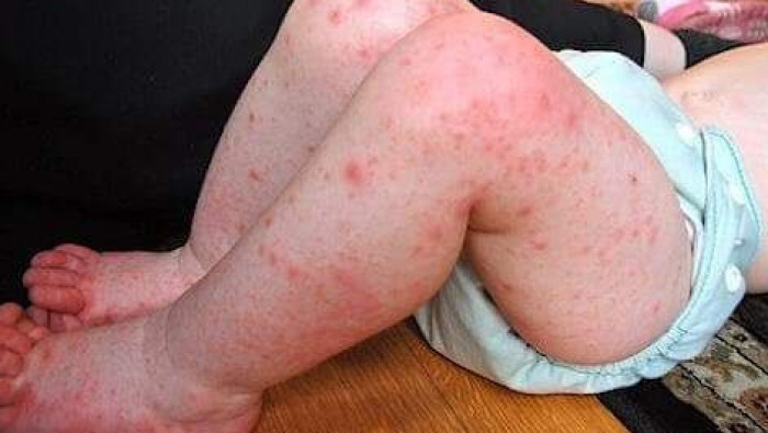 داء الفم والقدم ينتشر بين الطل...