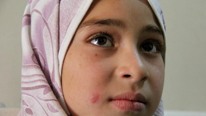 من جديد.. اللشمانيا تغزو ريف إ...