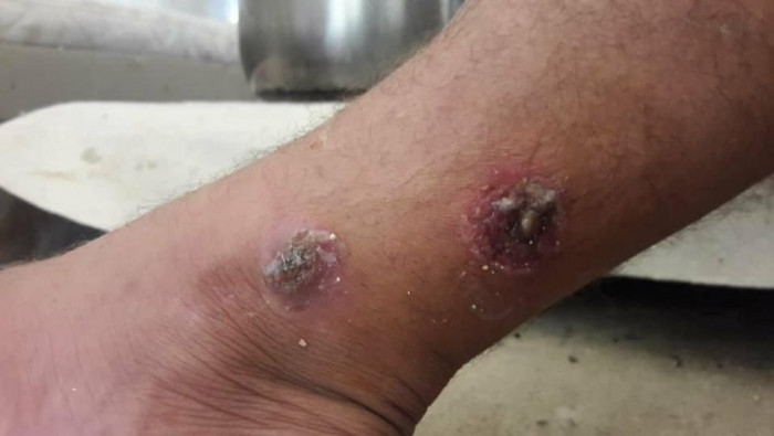 100 إصابة بداء "اللشمانيا" في...