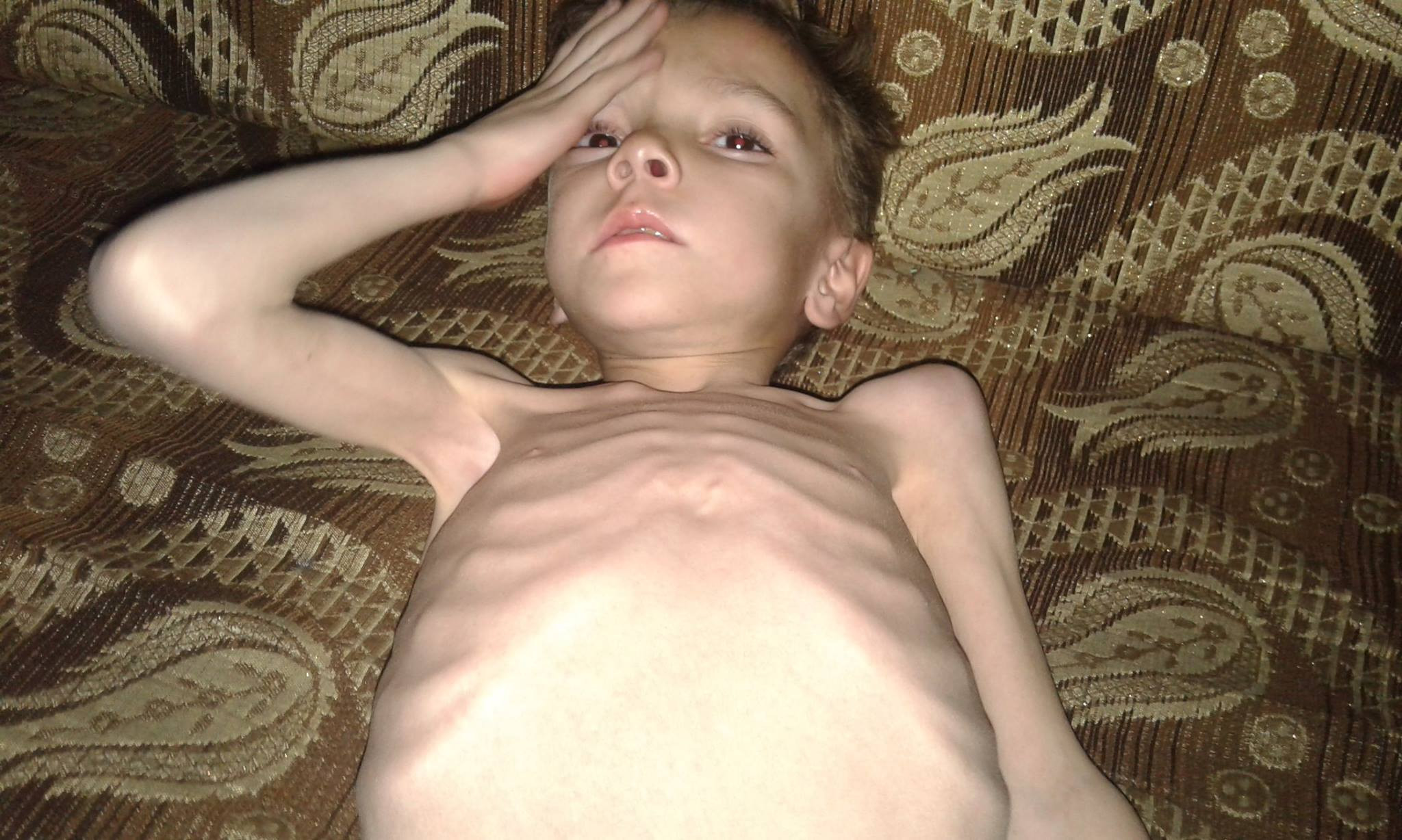 رغم دخول المساعدات.. سوء التغذ...