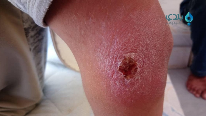 "اللشمانيا" تتفشى بين الأطفال...